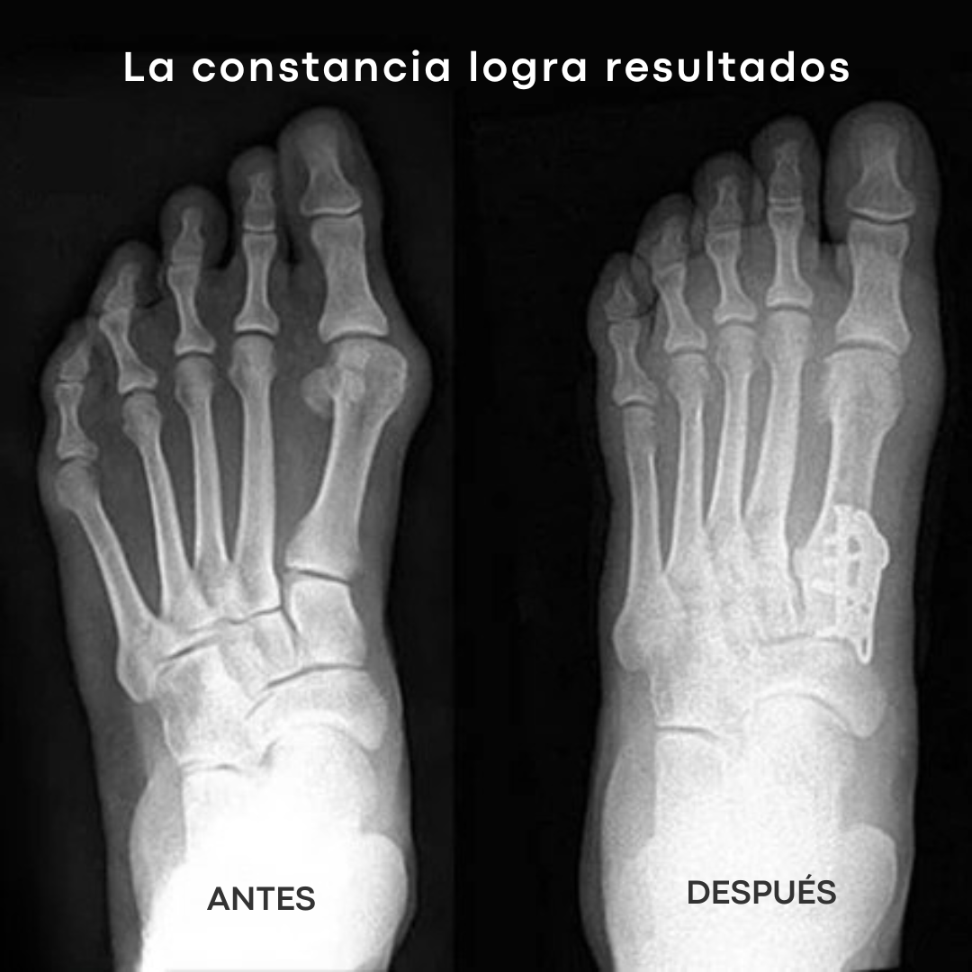 Corrector StepControl - Alinea y ayuda a frenar el avance del juanete